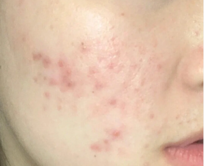 大腿突发红疹子常识解析及应对妙招